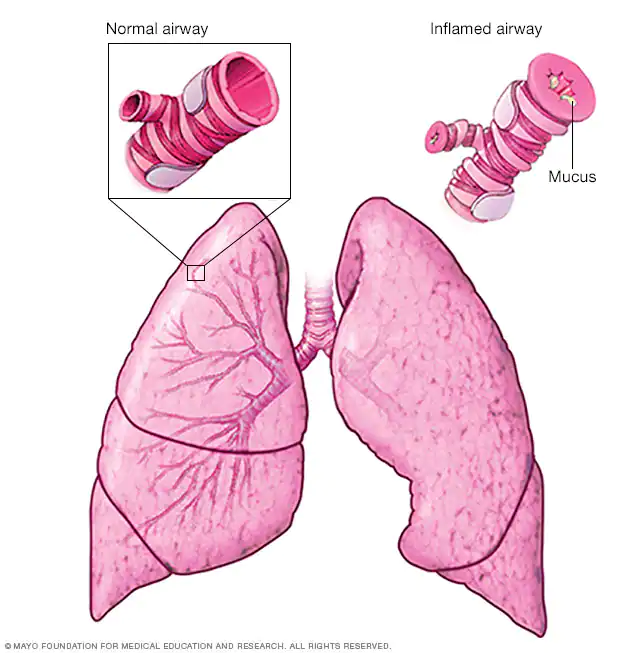 What Is Severe Asthma, Symptoms And Treatment